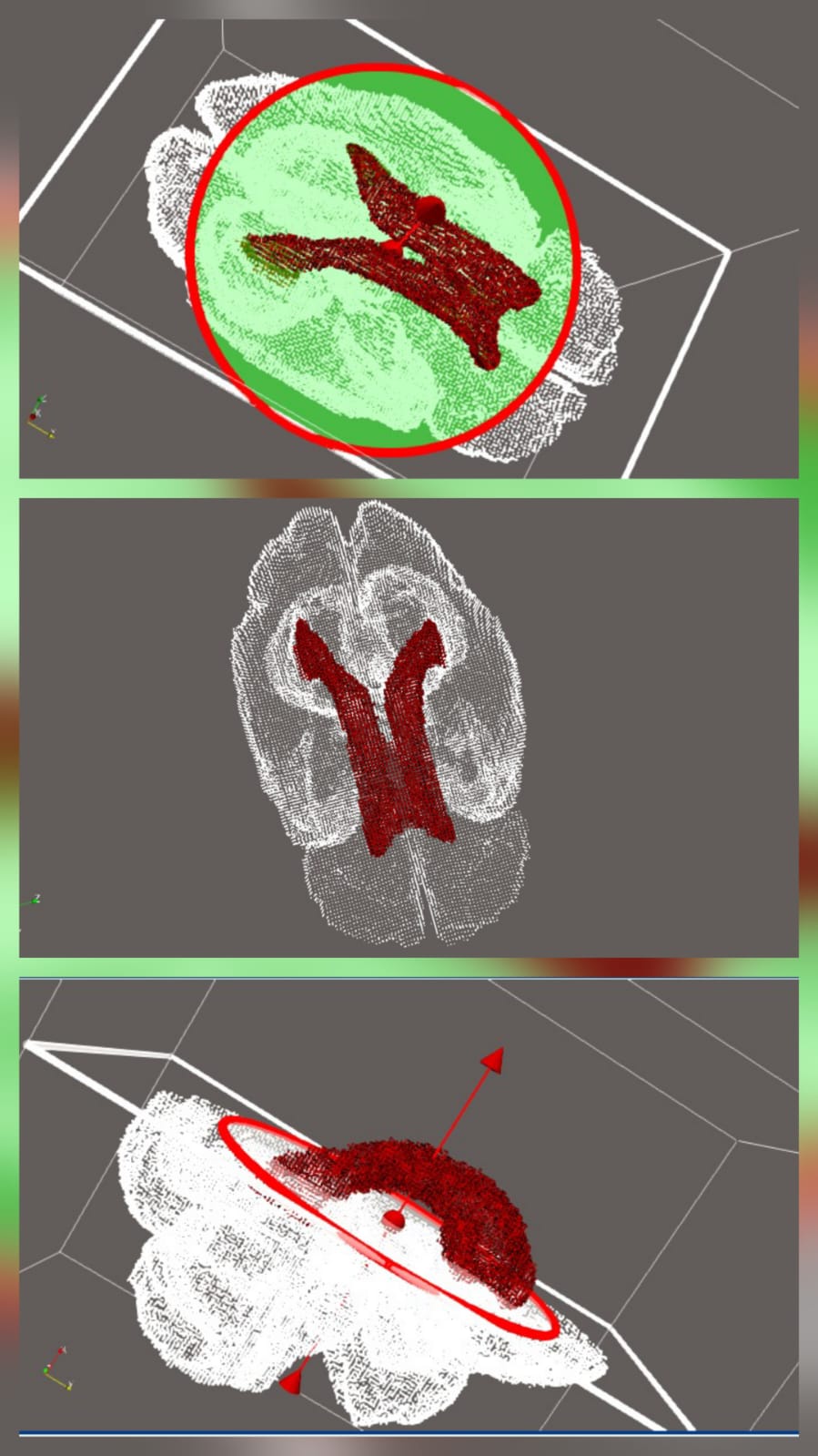 Three-dimensional boundary visualization of the brain surface and ventricular structure