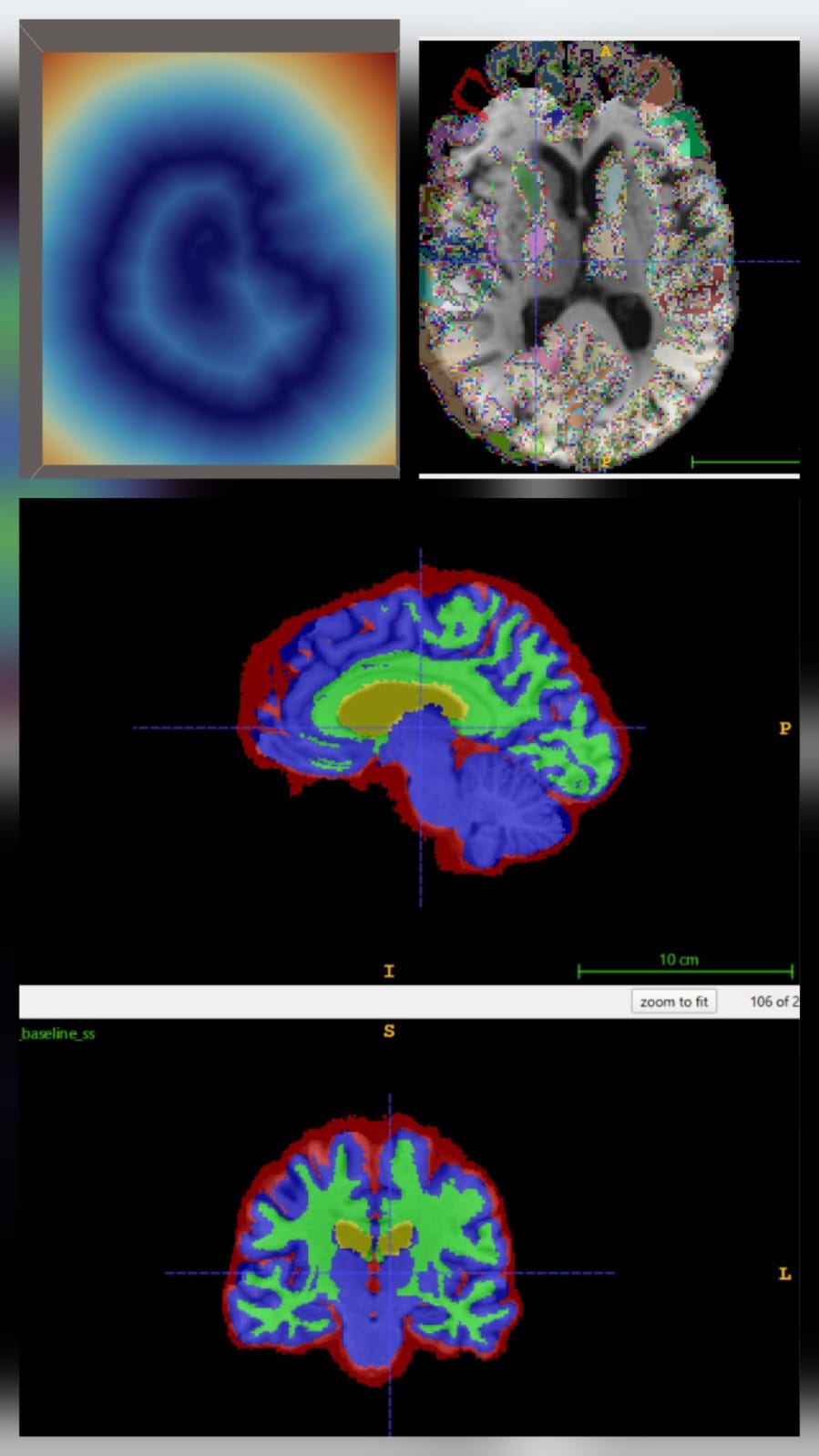 Signed distance field, T1 MRI slice, and multi-view brain segmentation visualization